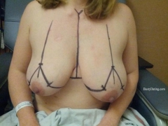 Busty Breast Reductions - Set 18 - N